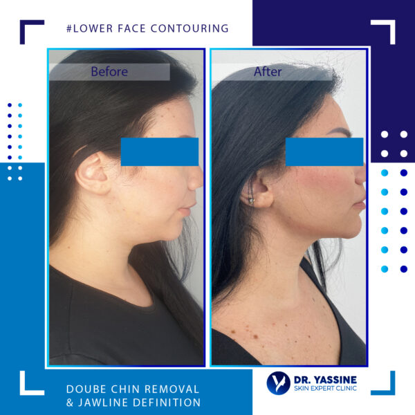 double chin removal