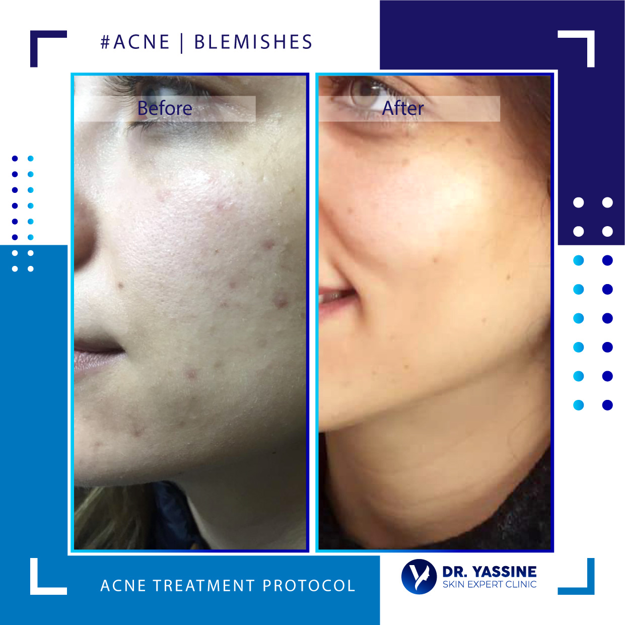 acne treatment protocol results