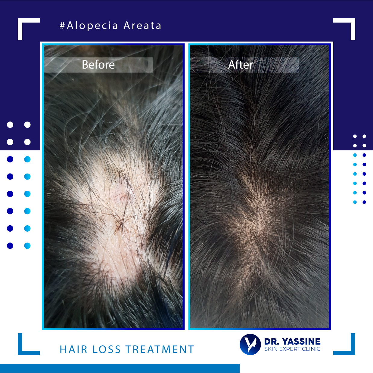alopecia areata treatment results