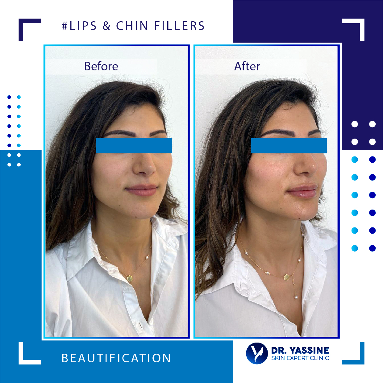 lips and chin fillers