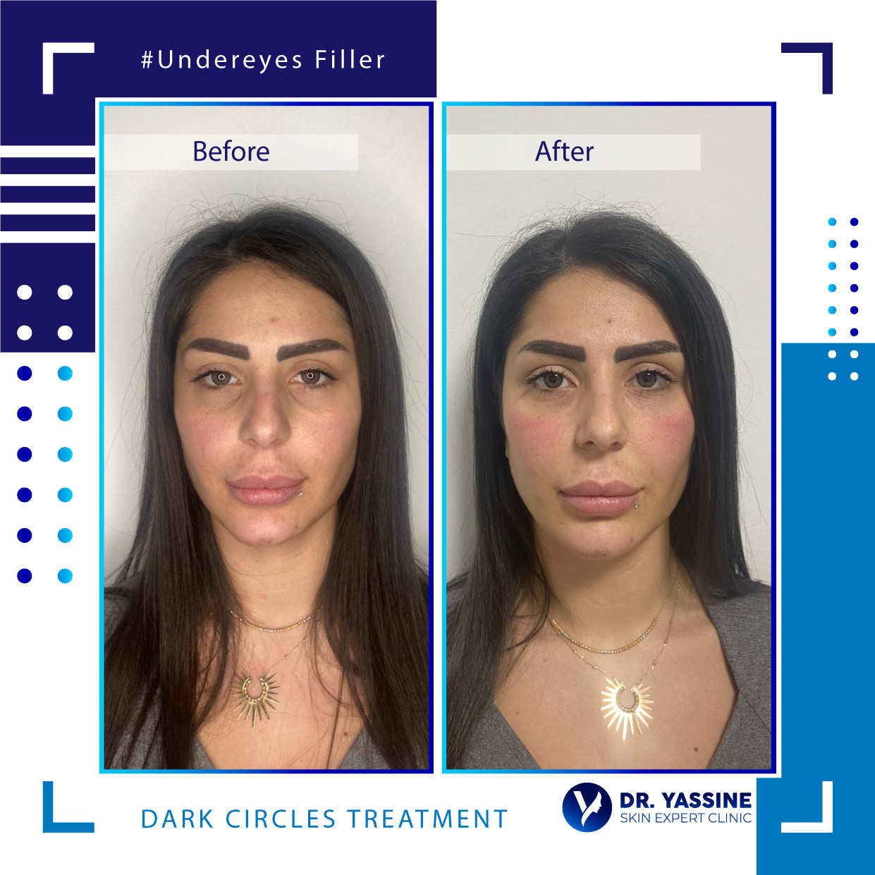 undereyes fillers treatment