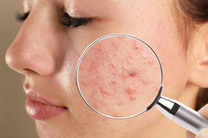 Are you wishing to get rid of the acne problem? Skin Expert Clinic has pioneering treatments for you!