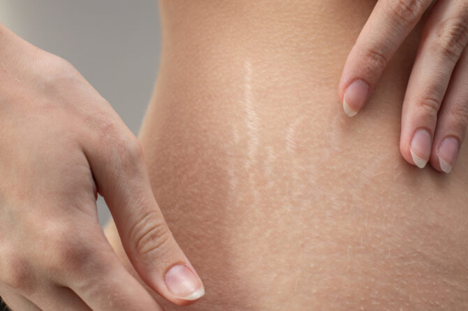 How Dr. Yassine excels in treating stretch marks?