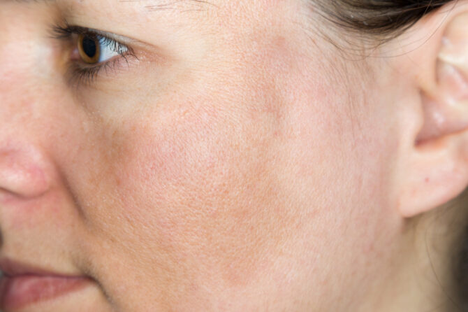 هل تبحثون عن علاجات للتصبّغات الجلدية؟ الحلول الفعّالة موجودة لدى Skin Expert Clinic