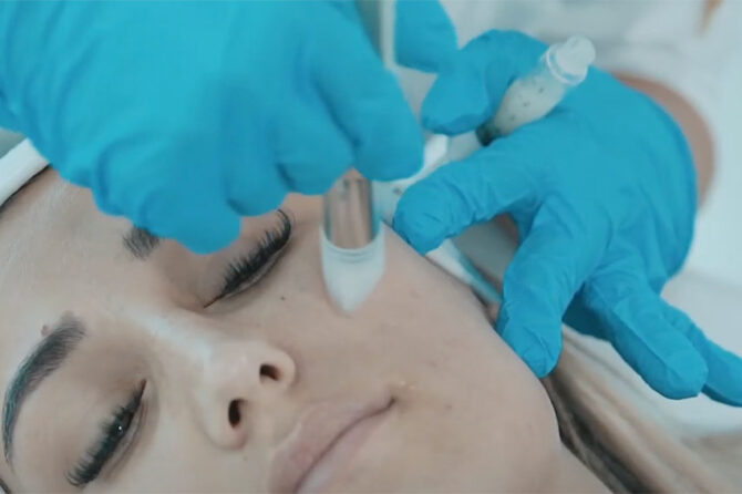 What are the secrets of the impressive Microneedling technique success at Skin Expert Clinic?
